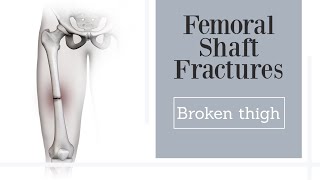 Femoral Shaft Fractures  broken thighbone [upl. by Gross102]