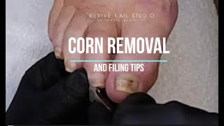 Corn removal pincer nail correction and nail cleaning Oh my pedicuretutorial pedicure corns [upl. by Anet]