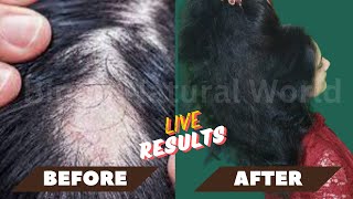 Receding Hairline Regrowth  Hair Regrowth at 40  Regrow Hair After 40 Going Natural from Chemical [upl. by Schlenger438]