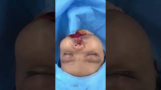 Best cleft lip plastic surgery hospital in India at Bangalore  Richardsons Face [upl. by Yevoc886]