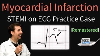 Myocardial Infarction  STEMI on ECG  Practice EKG [upl. by Yenohtna]