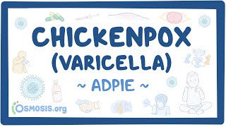 Chickenpox Varicella Nursing Process ADPIE [upl. by Acilgna]