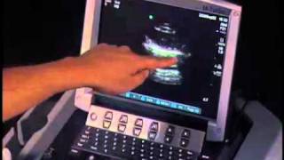 How to Pneumothorax Evaluation with Ultrasound [upl. by Laband800]