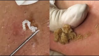 Most Satisfying Blackhead Removal Compilation Ultimate Extraction Videos [upl. by Aleehs]