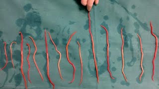 Doctors Remove 14 Roundworms From Woman [upl. by Fredric]