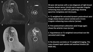 Fibrocystic Changes of the Breast Radiologic–Pathologic Correlation of MRI [upl. by Lekar]