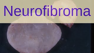 What is a Neurofibroma  Pathology mini tutorials [upl. by Uri]