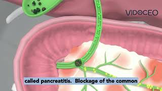 Choledocholithiasis explained [upl. by Brunell]