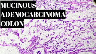 Mucinous Adenocarcinoma Colon Histopathology [upl. by Ennovad953]