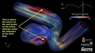 Investigating FlowStructure Interactions in Cerebral Aneurysms [upl. by Gasser858]