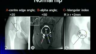 Femoroacetabular Impingement [upl. by Tory]