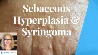 SEBACEOUS HYPERPLASIA VS SYRINGOMA  BEST REMOVAL PROCEDURES [upl. by Einafpets]