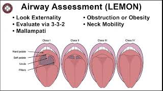 Placement of Supraglottic Airway SGA  شرح التنبيب الرغامي [upl. by Calmas]