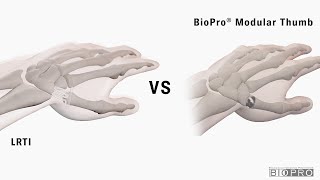 BioPro Modular Thumb Joint Replacement vs Traditional Surgery for Basal Thumb Arthritis [upl. by Ekralc752]