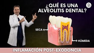 ALVEOLITIS dental Causas y tratamiento🦷 [upl. by Wardle]