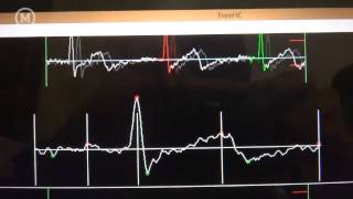 Electrocardiogram using Arduino and ECGEKG shield [upl. by Uriia]