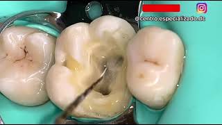 ¡Endodoncia en diente real [upl. by Leis]