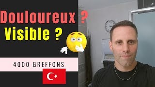 Greffe de cheveux FUE en Turquie Vidéo 14  Réponses aux questions 4000 Greffons [upl. by Noevad]