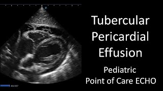 Tubercular Pericardial Effusion  Point of Care ECHO  Short Video [upl. by Notslar]