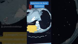 Angiotomografia de aorta abdominal [upl. by Eisiam]