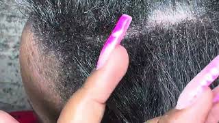 ITCHY DRY SCALP  FLAKY  DANDRUFF HAIR SCRATCHING ASMR [upl. by Deming611]