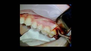 Maxillary Third Molar Surgery [upl. by Silohcin718]