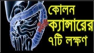 কোলন ক্যান্সারের ৭টি লক্ষণ ও চিকিৎসা Kalo Paikhana Karon Colon Cancer Treatmentক্যান্সার [upl. by Aioj363]