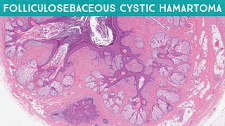 Folliculosebaceous Cystic Hamartoma aka Sebaceous Trichofolliculoma Dermpath Dermatology Pathology [upl. by Nuahsor]