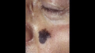 Squamous Cell Carcinoma and Lentigo Maligna Melanoma plus the precancerous conditions [upl. by Arim]