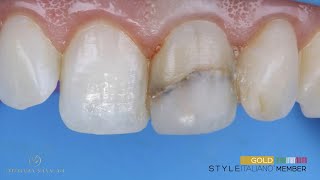 Direct composite bondingveneer for single tooth discolorations [upl. by Aerbua]