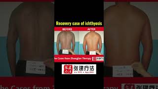 Recovery case of lamellar ichthyosis ichthyosisskincaredermatologistdryskinremedyskintreatment [upl. by Dearden]