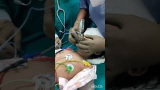 Pediatric LMA Insertion [upl. by Marolda]