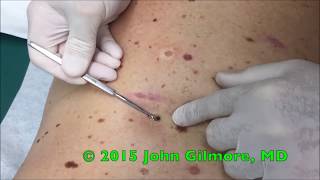 Multiple Dilated Pores  Blackhead Extractor [upl. by Dena299]