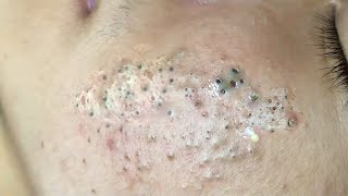 Big Cystic Acne Blackheads Extraction Blackheads amp Milia Whiteheads Removal Pimple Popping  3798 [upl. by Kaz]