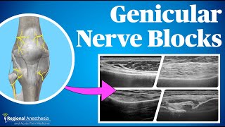 Ultrasound Guided Genicular Blocks 2024 update [upl. by Gregorius]