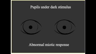 Paradoxical Pupillary Response [upl. by Armilla357]