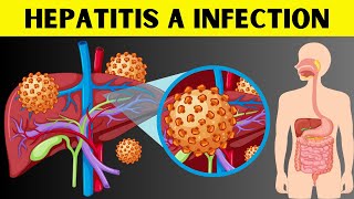 Hepatitis A Infection  Signs amp Symptoms Risk Factors Virology Diagnosis And Treatment [upl. by Idurt]