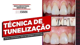 Técnica da Tunelização  Cirurgia Periodontal para Recobrimento Radicular [upl. by Kolk580]