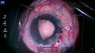 CAPSULAER FOR A SUBLUXATED CATARACT [upl. by Sukey]