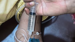 Intravenous injection Iv ceftriaxone Triporce 1g  injection video 24 P15 by cannula sixtynine [upl. by Novi]