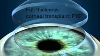 Full Thickness Corneal Transplantation Penetrating Keratoplasty PKP [upl. by Liebowitz]