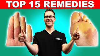 Raynauds Syndrome Top 15 Remedies Symptoms amp Best Treatment [upl. by Anitan952]