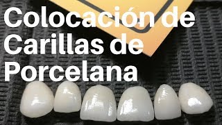 COLOCACIÓN de CARILLAS de Porcelana👅carillasdentales [upl. by Grory]