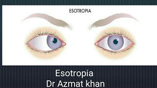 Esotropia its classifications and management Part 12 [upl. by Welcher]