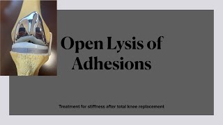 Open Lysis of Adhesions Surgical treatment for severe stiffness after total knee replacement [upl. by Aihselef]