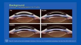 Quality of Life Before and After Keratoplasty for Fuchs Endothelial Dystrophy [upl. by Dazraf]