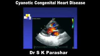 Cyanotic Congenital Heart Disease Dr S K Parashar [upl. by Enilegnave145]