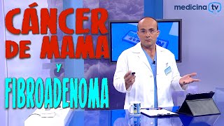 CÁNCER DE MAMA y FIBROADENOMA ¿Alguna relación ¿Aumenta el Riesgo  CÁNCER 28 [upl. by Marni170]