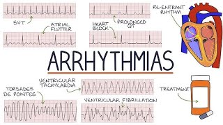 Hospital Training  Internal medicine  Arrhythmias Dr Mohammed Mahdi 20242025 [upl. by Dnaltiak]