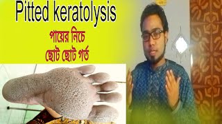 Pitted keratolysis  Pitted keratolysis treatment  পায়ের নিচে ছোট ছোট গর্ত হয়ে যাওয়া। [upl. by Atteuqaj]